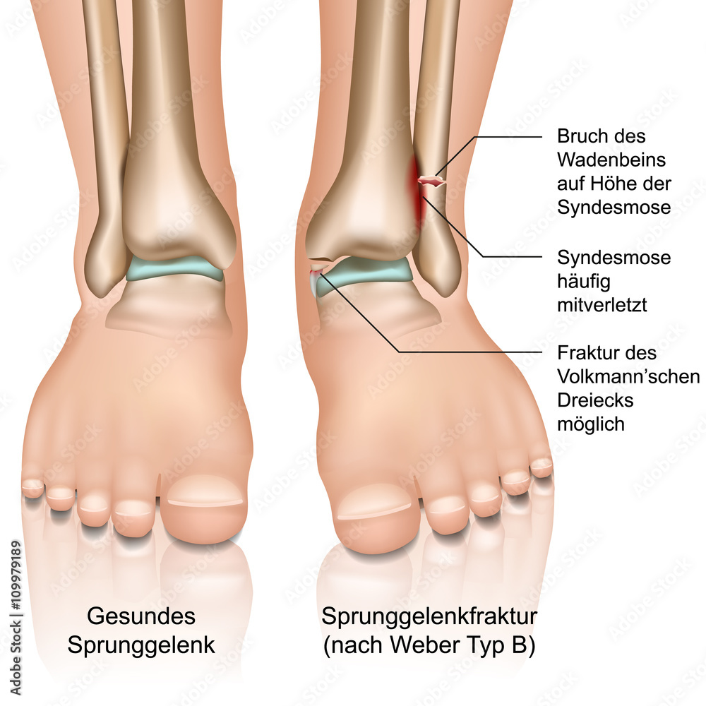 Sprunggelenkfraktur nach Weber Typ B Stock Vector Adobe Stock
