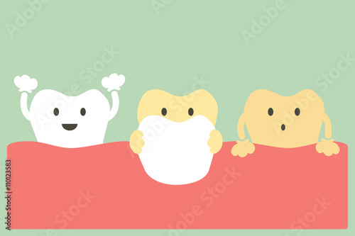 veneers teeth