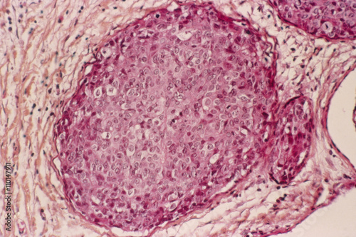 Breast cancer