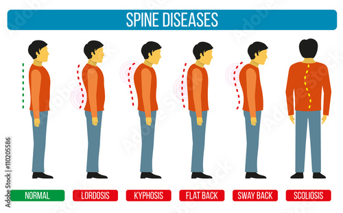 Body posture defect. Vector infographics of spine diseases. Scoliosis and lordosis medical diagrams photo