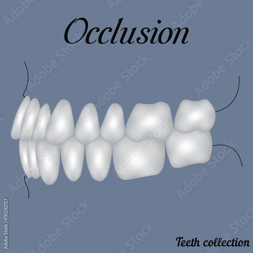 occlusion side view