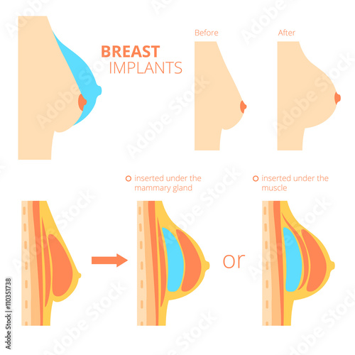 Breast augmentation infographics. 