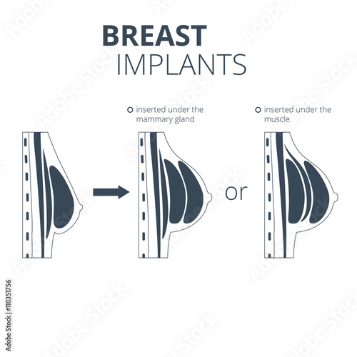 Isolated breast augmentation infographics.