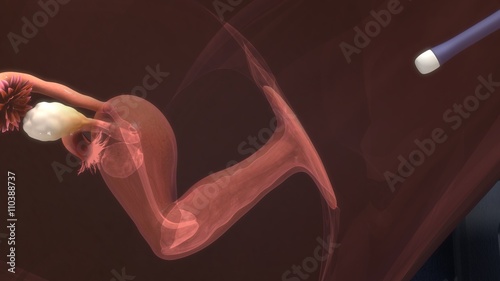 Εκτύπωση καμβά Follicle aspiration