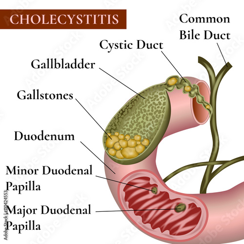 Сholecystitis. Inflammation of the gallbladder and bile ducts. Gallstones.
Cholelithiasis. Calculous cholecystitis. photo