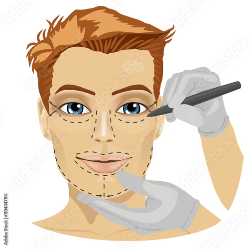 Guide lines for surgical incisions on a patient male face