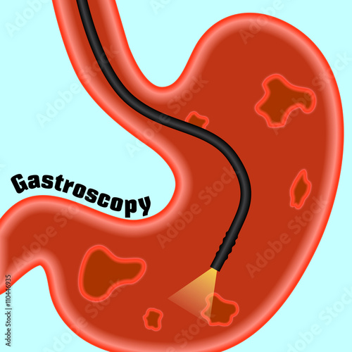 Gastroscopy, research of a stomach gastroscope. Helicobacter pylori. Ulcers. The disease of the stomach and duodenum. Сaricature, cartoon. photo