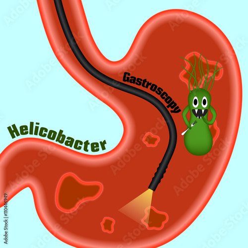 Gastroscopy, research of a stomach gastroscope. Helicobacter pylori. Ulcers. The disease of the stomach and duodenum. Сaricature, cartoon.