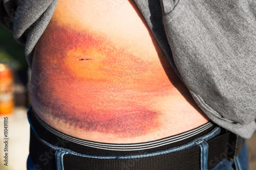 Person revealing an extravasation injury
