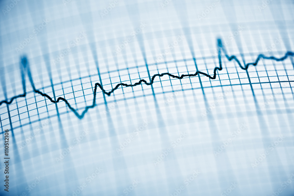 Electrocardiogram Electrocardiogram