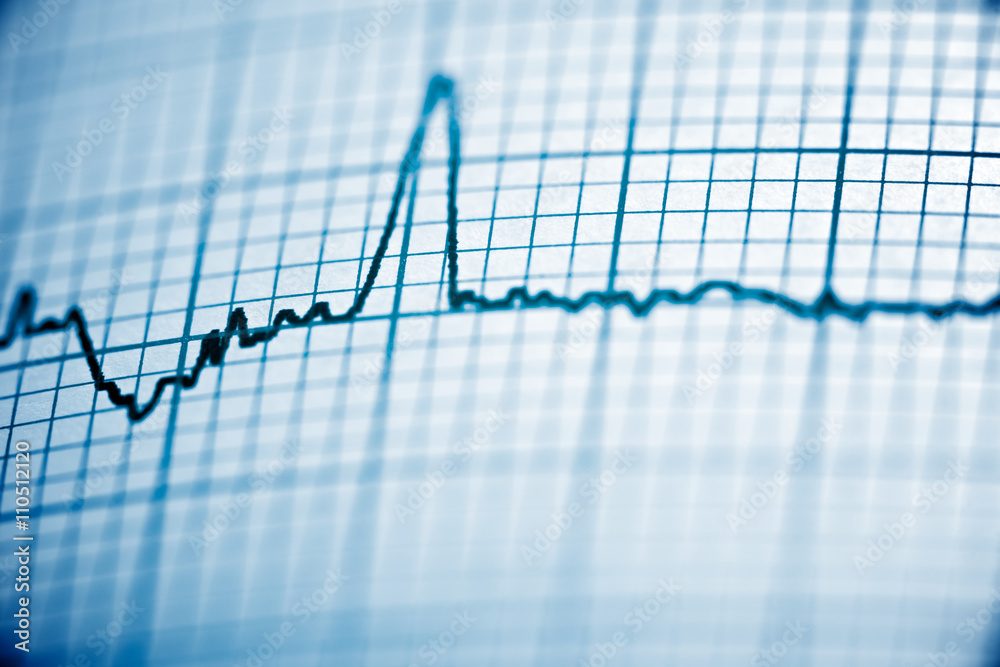 Electrocardiogram Electrocardiogram