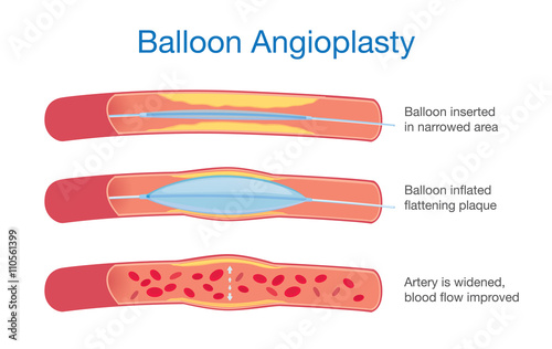 Balloon angioplasty procedure to expanded artery for blood flow improved. This illustration about medical. photo