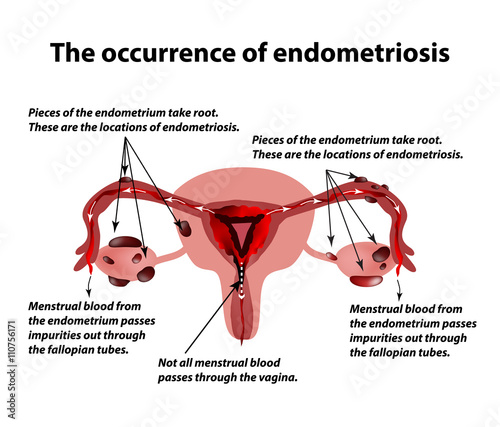 Endometriosis. The appearance of the disease endometriosis. Endometrium. Infographics. Vector illustration