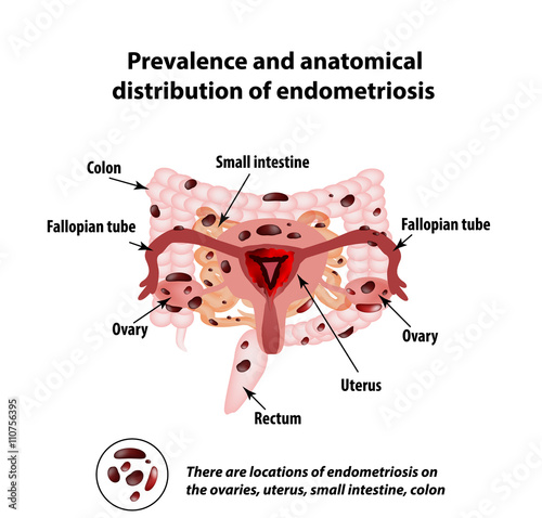 Endometriosis. The appearance of the disease endometriosis.  Endometrium. Colon. Small intestine. Infographics.  photo