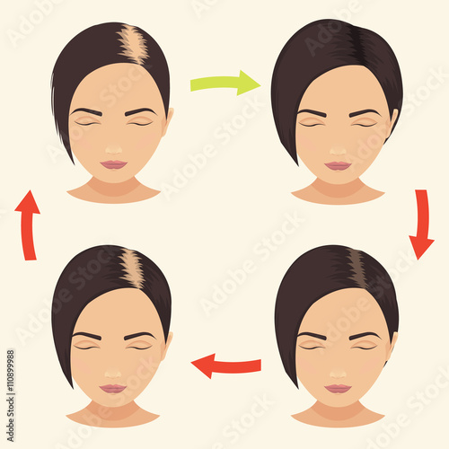 Female hair loss stages set. Woman before and after hair treatment and hair transplantation. Female pattern baldness. Implantation of hair. Vector illustration.
