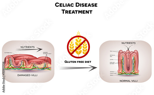 Celiac disease treatment. Gluten free diet leads to healthy intestinal villi. Illustration shows unhealthy villi with damaged cells and healthy villi.
