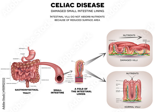 Gastrointestinal tract anatomy and Celiac disease affected small intestine villi. Unhealthy villi with damaged cells and healthy villi. Intestinal villi do not absorb nutrients  photo