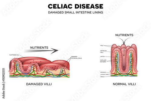 Celiac disease affected small intestine villi. Unhealthy villi with damaged cells and healthy villi. Intestinal villi do not absorb nutrients because of reduced surface area.