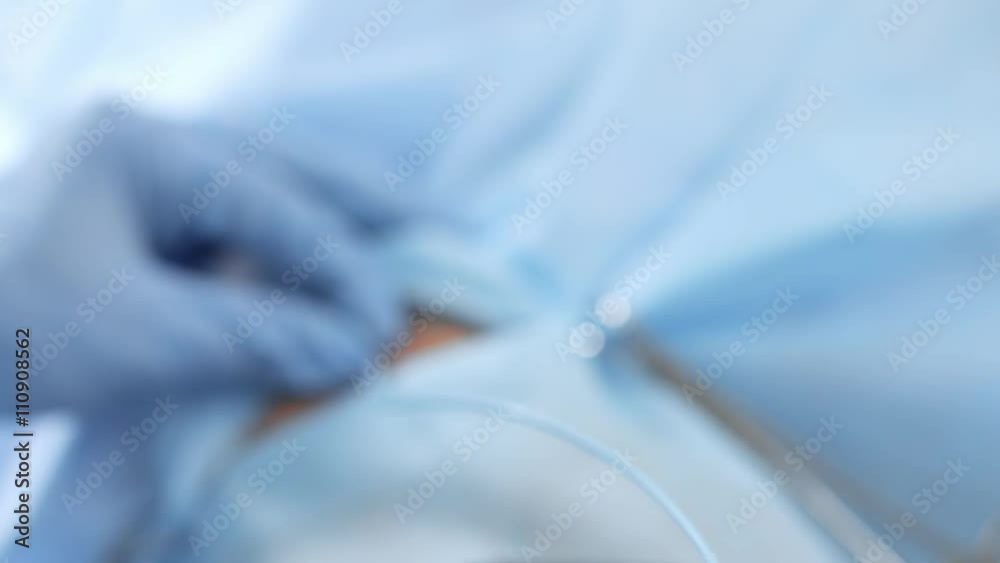 Angiographic Catheter Uterine fibroid embolization procedure. vídeo de Stock Adobe Stock