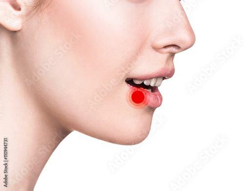 Sore on the female lips