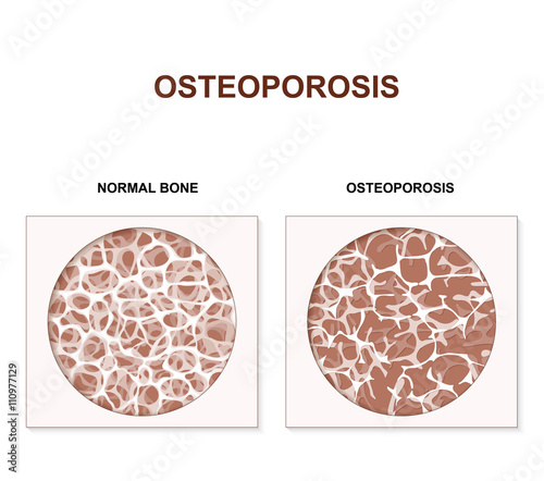 Osteoporosis
