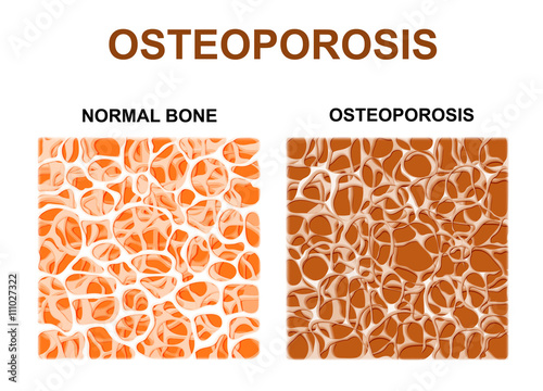 normal bone and bone with osteoporosis