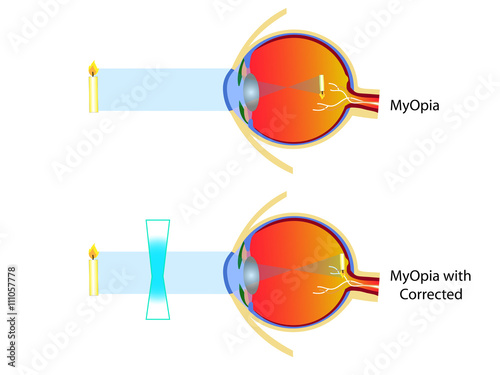  Myopia