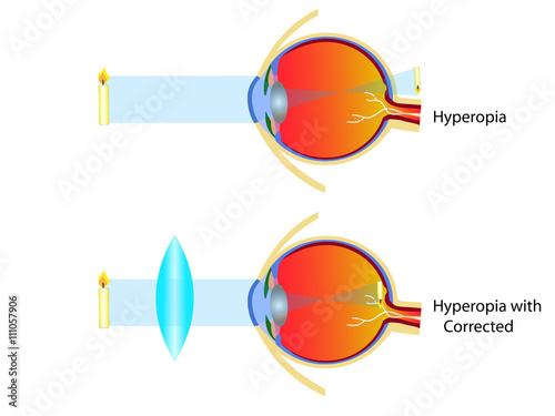 Hyperopia