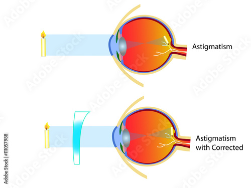 Astigmatism