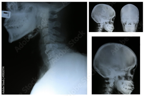 collection of film x-ray
