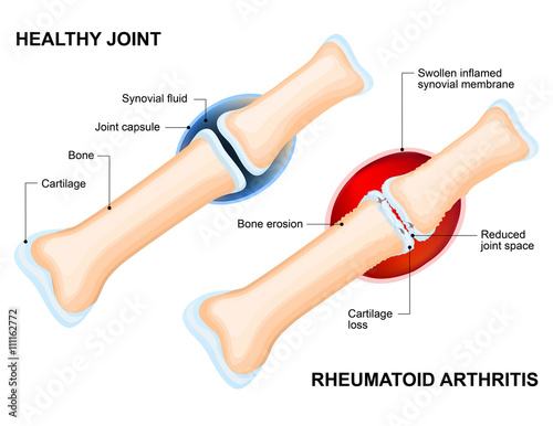 Normal Joint and Rheumatoid Arthritis