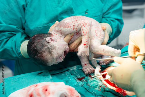 Tapet Real operation for cesarean section with new born infant in operating theater