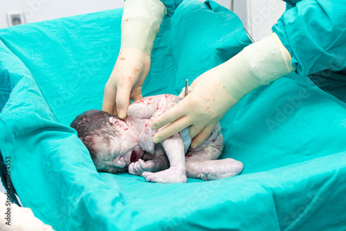 Real operation for cesarean section with new born infant in operating theater.