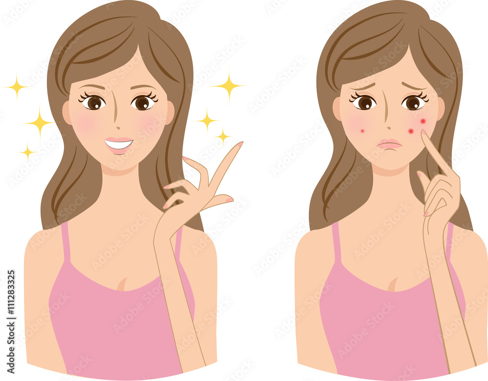 女性　肌の悩み　ニキビ
