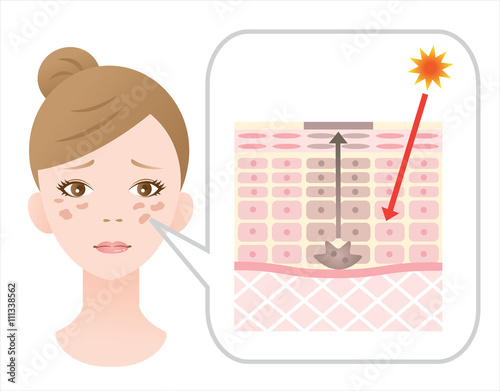 しみ肌の女性