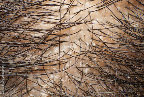 Dandruff on scalp and dark hair. Macro shot photo