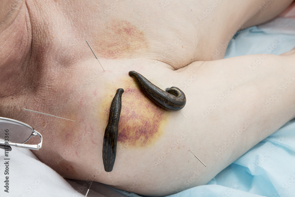 Treatment of medical leeches people and acupuncture. Photos