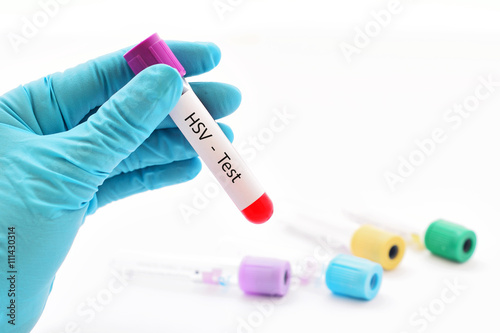 Photos Herpes simplex virus (HSV) test