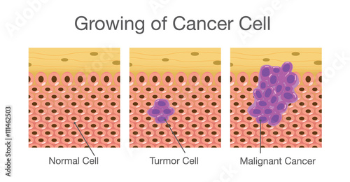 Growing and invasive of cancer cell in human. Medical illustration.