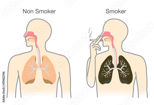 Comparison between lung of smoker and non smoker. This illustration about medical.