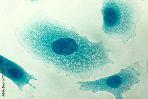 Vászonkép PC-3 human prostate cancer cells