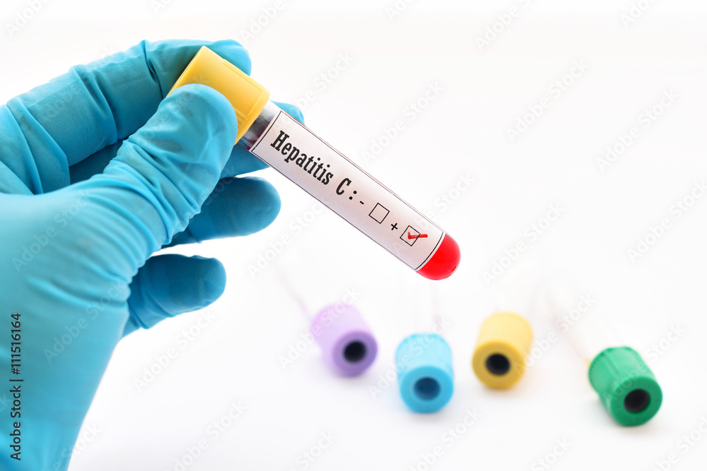 Fototapeta premium Hepatitis C virus positive