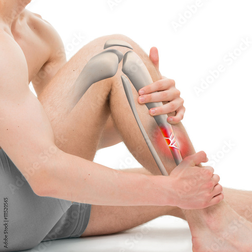 Tableau sur toile Comminuted Fracture of the Tibia - Leg Fracture 3D illustration