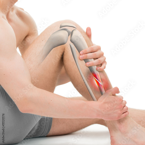 Fototapeta Oblique Fracture of the Tibia - Leg Fracture 3D illustration