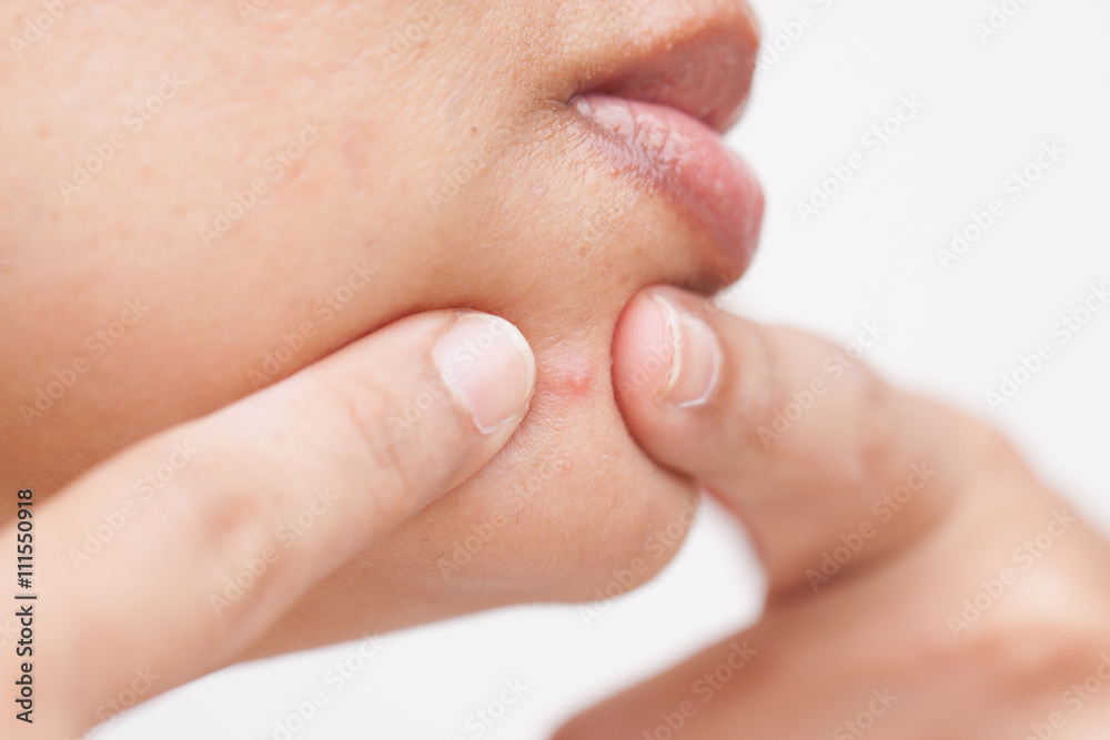 Obraz premium Woman, squeezing pimples, facial.