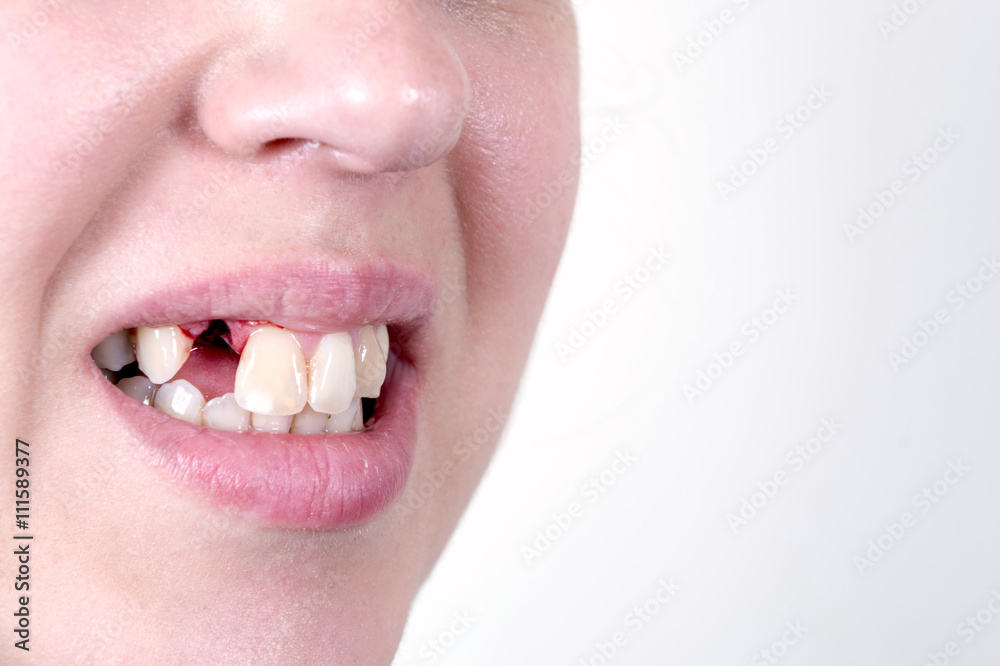 Naklejka premium Female without tooth 