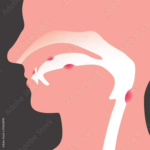 oral disease, image illustration photo