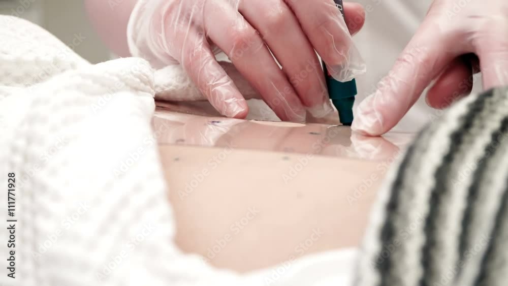 thick elderly woman prepares to medical liposuction. Doctor draws marker, mark on the abdomen. Reshiyut obesity clinic of plastic surgery thick elderly woman prepares to medical liposuction. Doctor draws marker, mark on the abdomen. Reshiyut obesity clinic of plastic surgery
