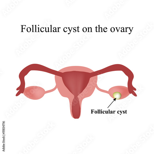 Follicular ovarian cyst. Functional cyst. Infographics. Vector illustration on isolated background