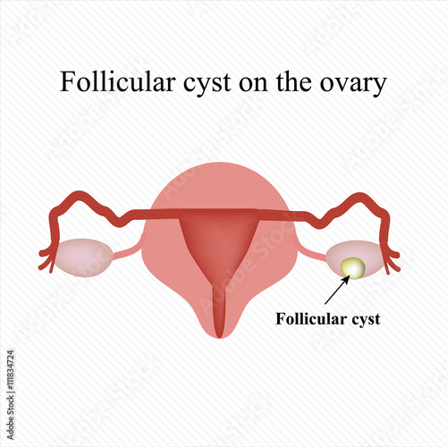 Follicular ovarian cyst. Functional cyst. Infographics. Vector illustration